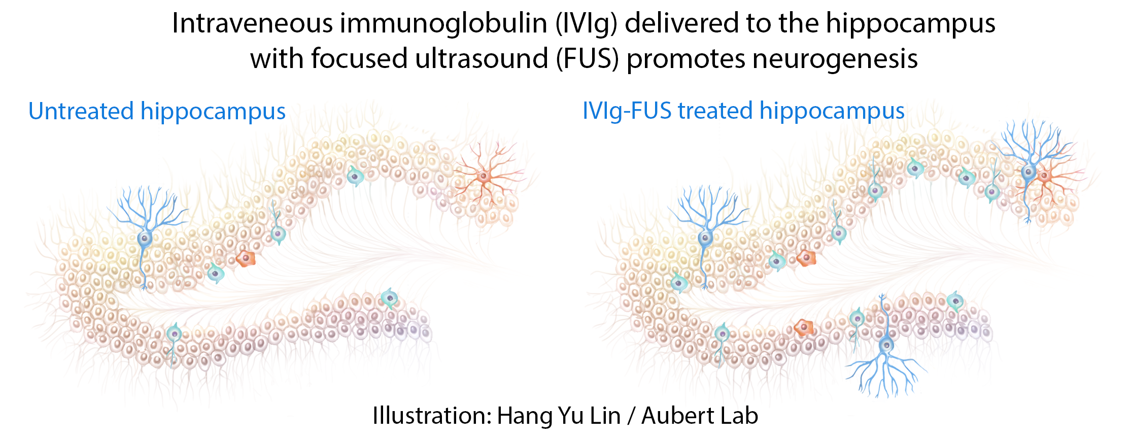 IVIg FUS Brain Neuron Illustration Lin Aubert 