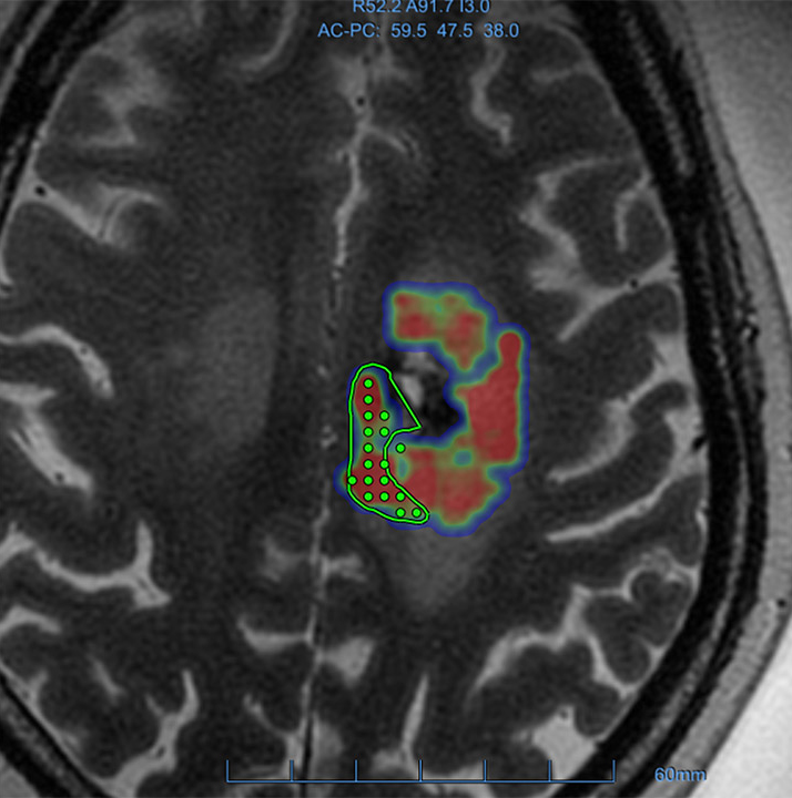 brain scan fus Sunnybrook liquid biopsy study