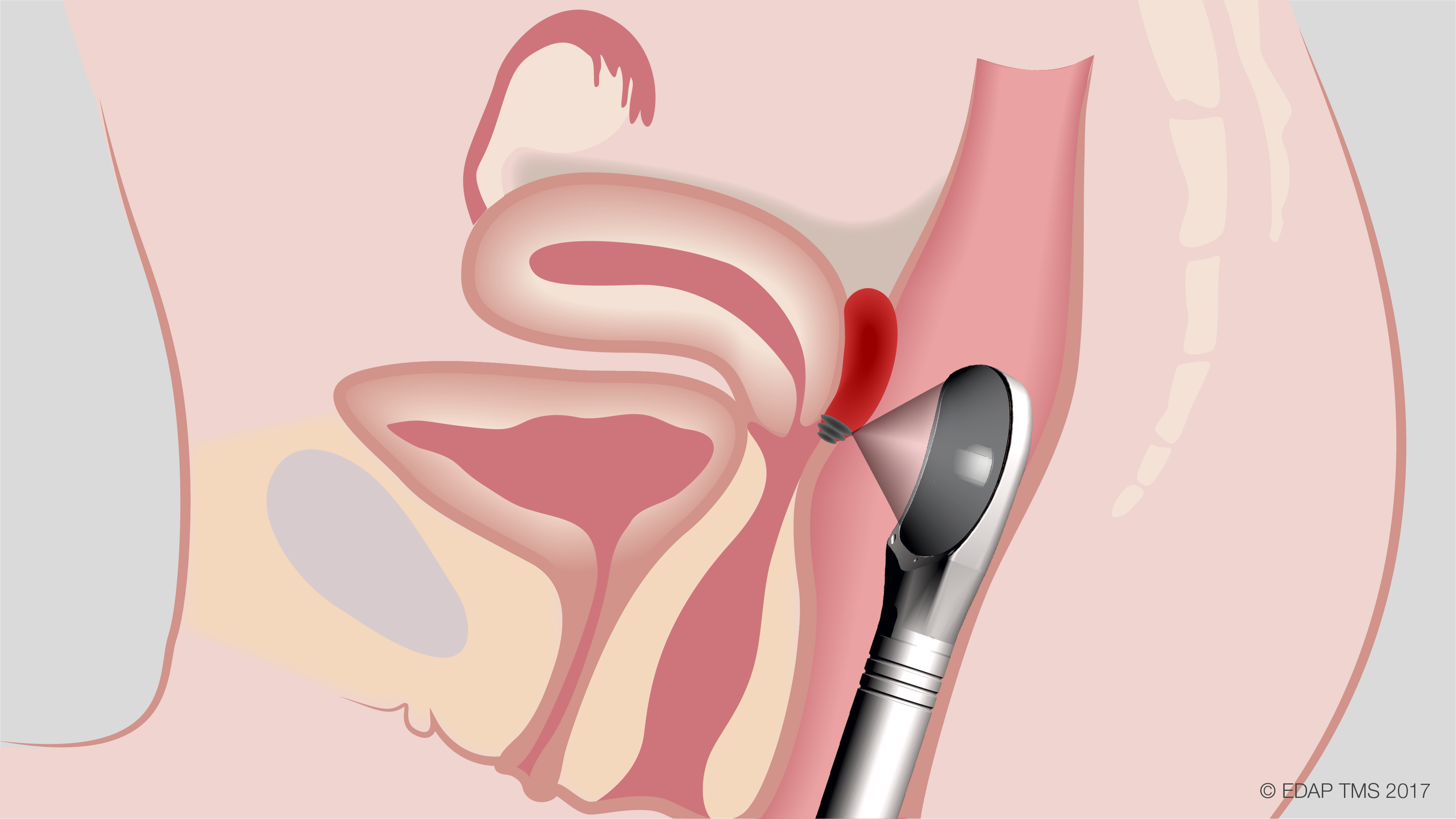illustrations endometriose 03 provided by EDAP