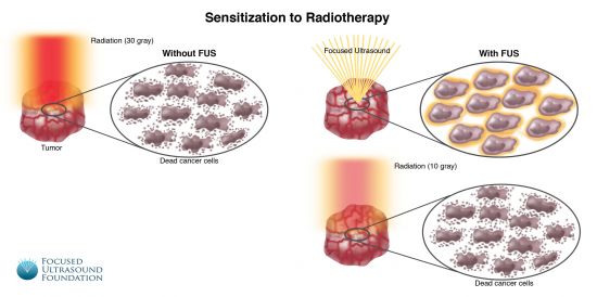 FUF-SensitizationRadiotherapy-FINAL