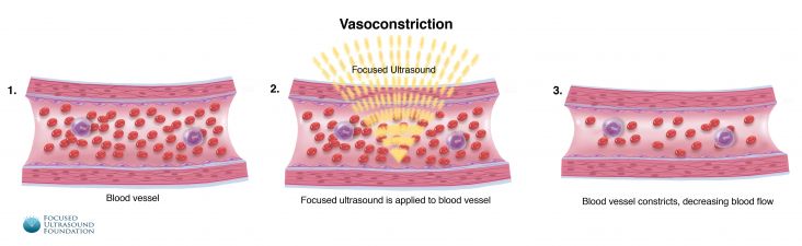 FUF-Vasoconstriction-FINAL